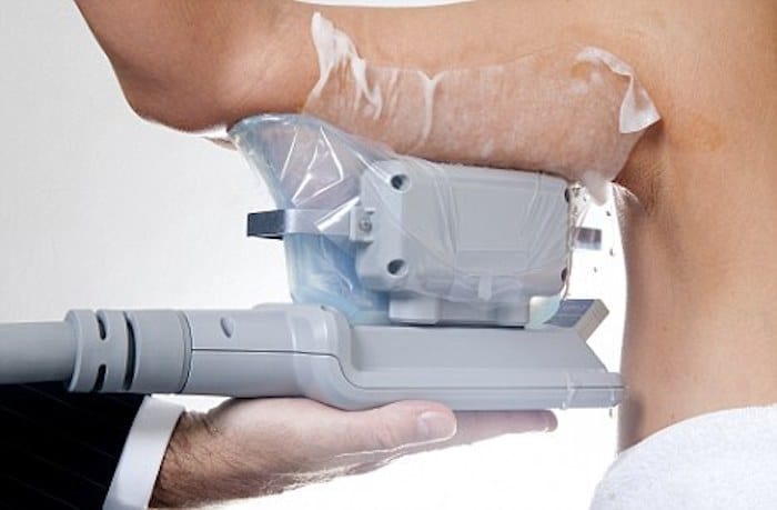 fat freezing arms Ellesmere Port