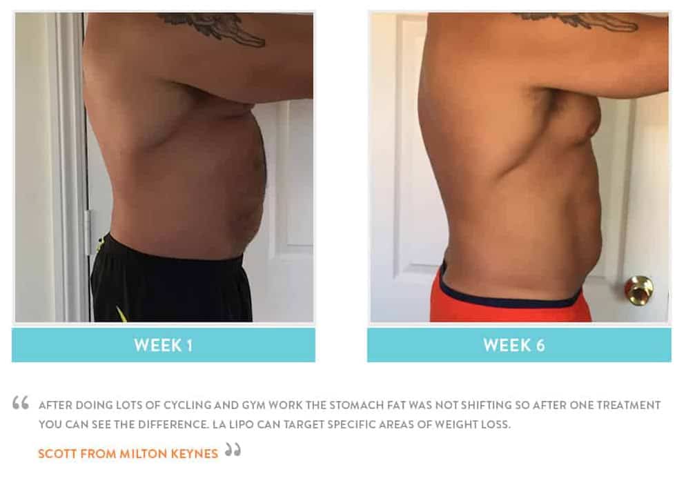 Before & After Stomach Fat Ellesmere Port