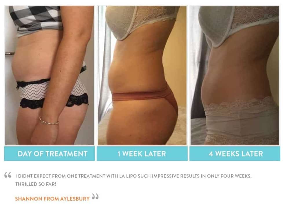 before, Cryolipolysis Ellesmere Port