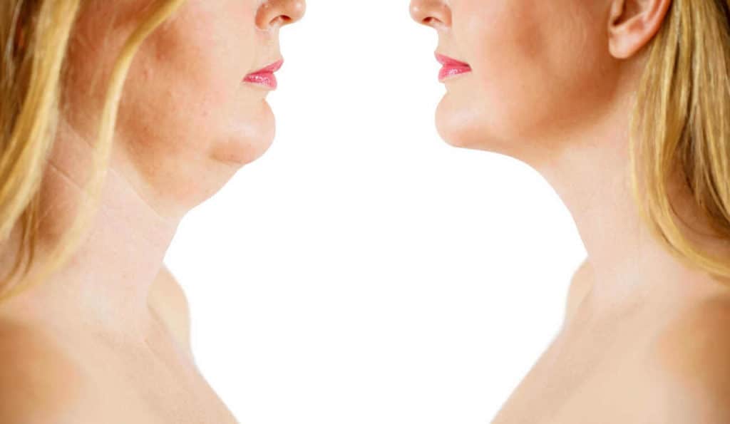 Double Chin treatment Ellesmere Port before and after results