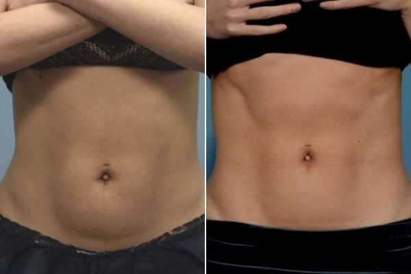 body sculpting FAQs Ellesmere Port