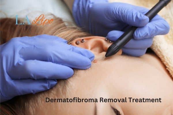 Dermatofibroma Removal Treatment Ellesmere Port