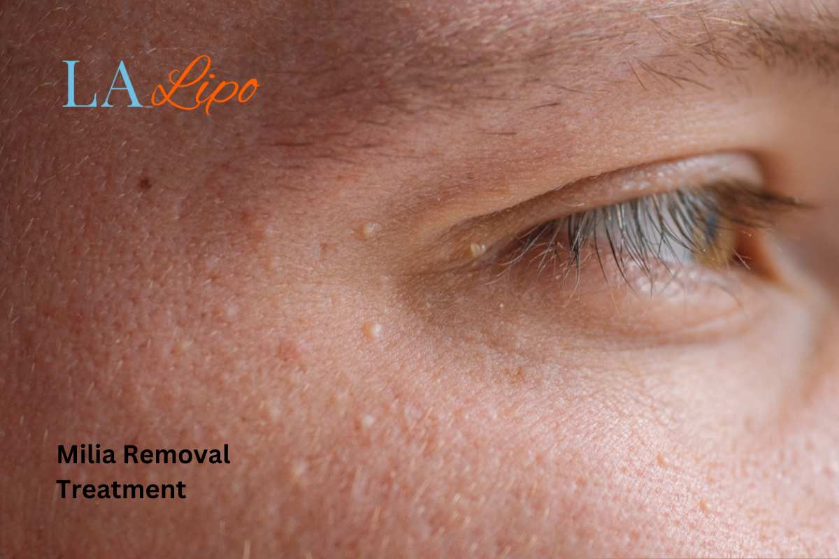 Cryopen Milia Removal: Is It the Easiest and Safest Option Ellesmere Port?