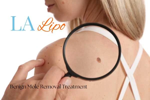 Why getting moles removed Ellesmere Port can boost your confidence!