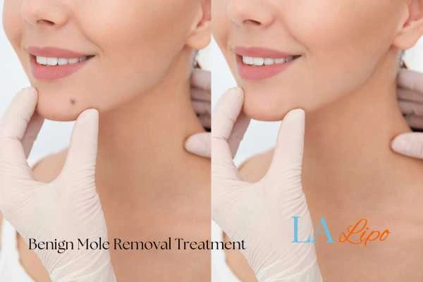 woman's before and after mole removal Ellesmere Port results