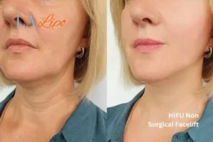 hi-fu for wrinkles Ellesmere Port before and after results