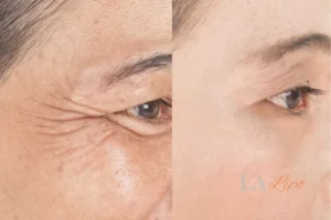 Before and after results of woman - HI-fu wrinkles reduction treatment Ellesmere Port