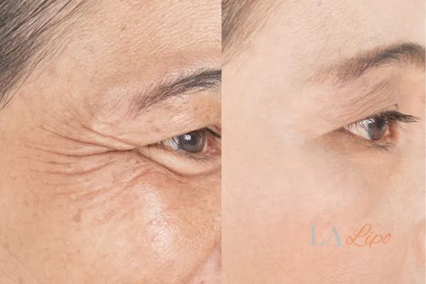 Before and after results of woman - HI-fu wrinkles reduction treatment Ellesmere Port