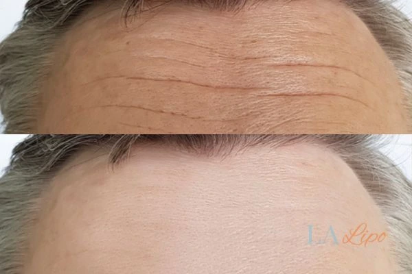 results of HIFU Ellesmere Port on mans forehead to help reduce lines and wrinkles
