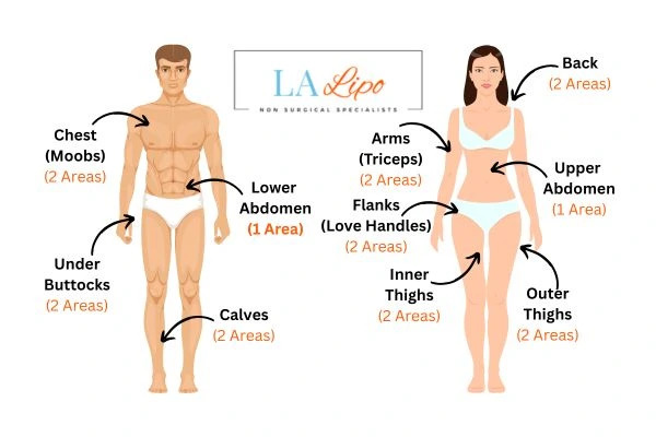 LA LIPO Cryolipolysis Areas Ellesmere Port