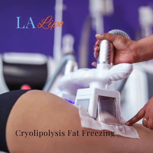 fat freezing - Cryolipolysis Ellesmere Port