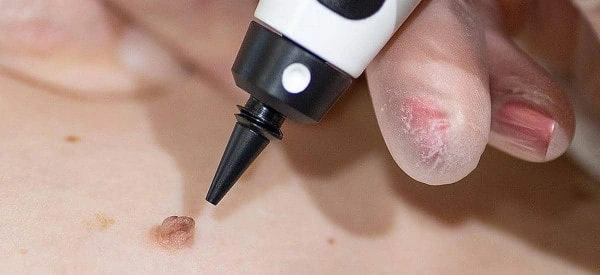 skin tag removal using cryopen Ellesmere Port