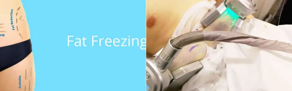 multi areas of a persons body having coolsculpting Ellesmere Port treatment