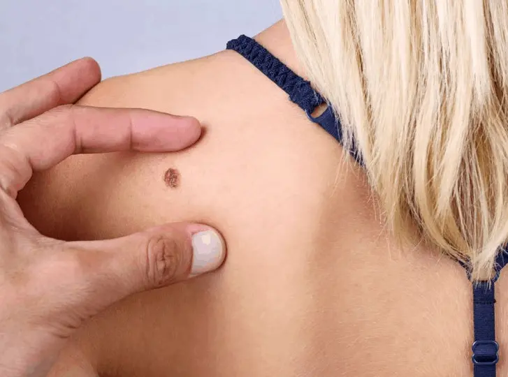 woman having mole removal Ellesmere Port consultation before treatment.