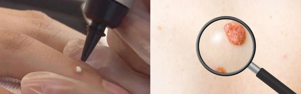 Person getting moles removed with cryopen Ellesmere Port