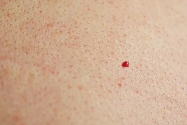 close up of a cherry angioma Ellesmere Port