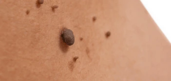image of a skin tag Ellesmere Port