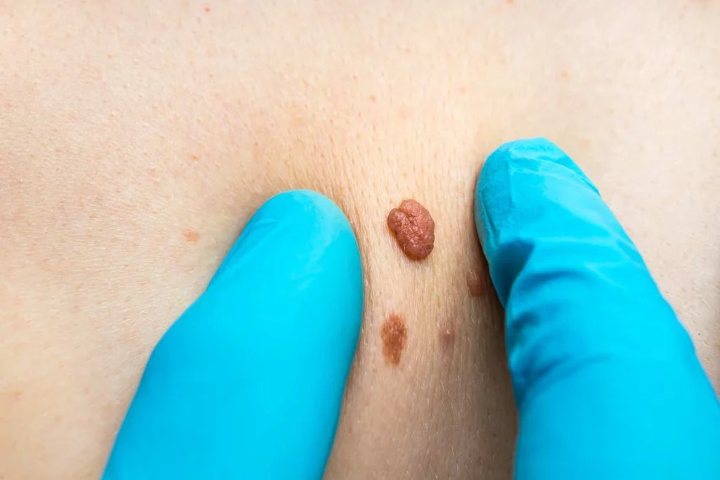 Consultant examining a skin tag Ellesmere Port