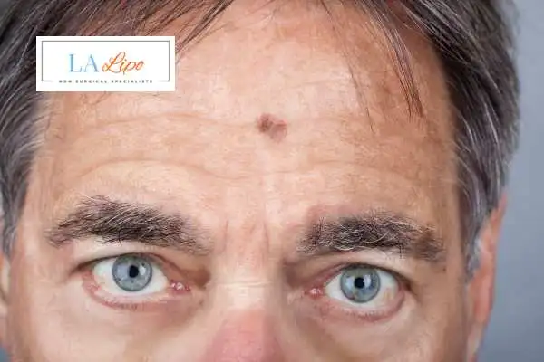 Solar Lentigo Removal Ellesmere Port image of man with mark on his forehead