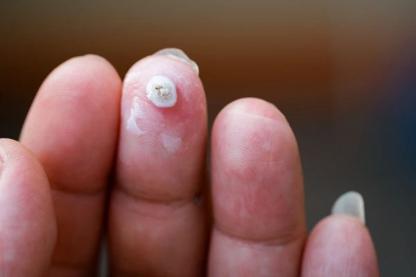 wart on person finger - cryotherapy to treat from LA LIPO Ellesmere Port