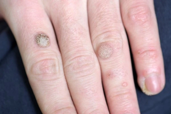photo of warts on person hand - see wart removal Ellesmere Port from LA LIPO