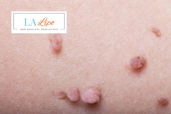 Does cryopen skin tag removal Ellesmere Port hurt? Find out now call our team today!