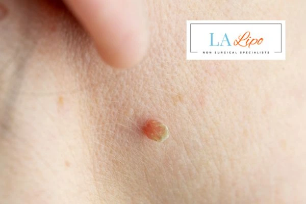 Book skin tag removal Ellesmere Port today speak to our team now!