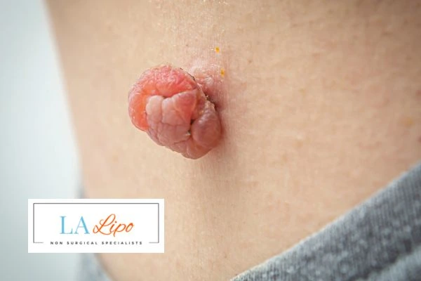 Interested in skin tag removal Ellesmere Port? Concerned about the pain? Find out more today!