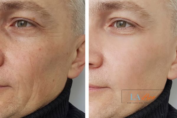 See the amazing results of Morpheus8 Treatment Ellesmere Port!