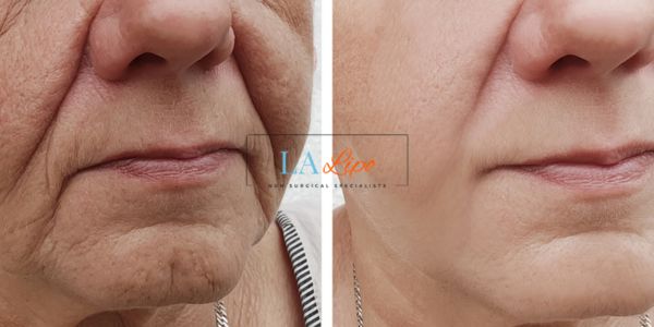 Older lady deeper wrinkle reduction - LA LIPO Morpheus 8 Results Ellesmere Port