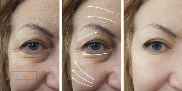 Amazing eye lift Morpheus 8 results Ellesmere Port