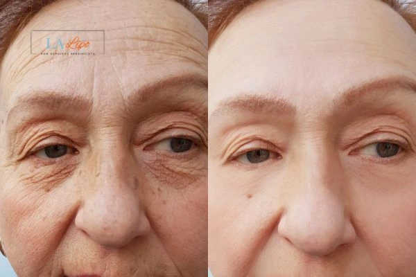 The powerful benefits of Morpheus8 Treatment Ellesmere Port - Call Our team today!