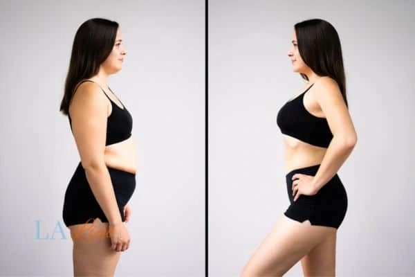 Picture of womans before and after using LA-EMS body sculpting to improve her core strength Ellesmere Port