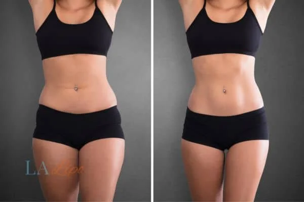 before and after results of non-surgical treatment to help a woman's body image and mental health Ellesmere Port