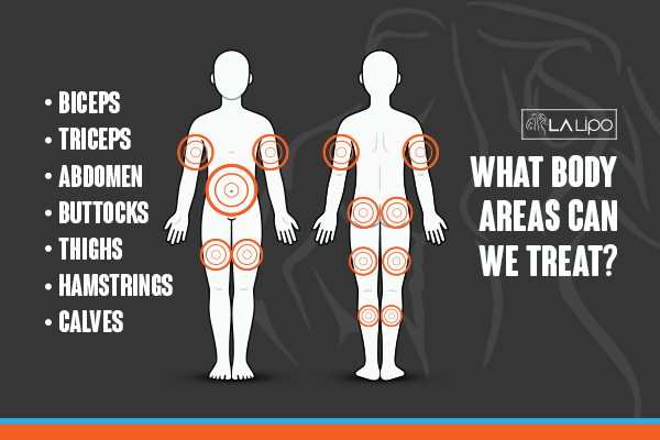 Diagram to show areas you can have LA-EMS Body Sculpting Treatment Ellesmere Port