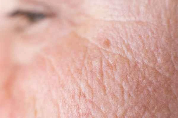 close up picture of a woman's face showing an age spot Ellesmere Port