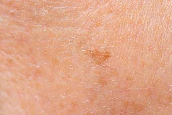 close up picture of age spots Ellesmere Port