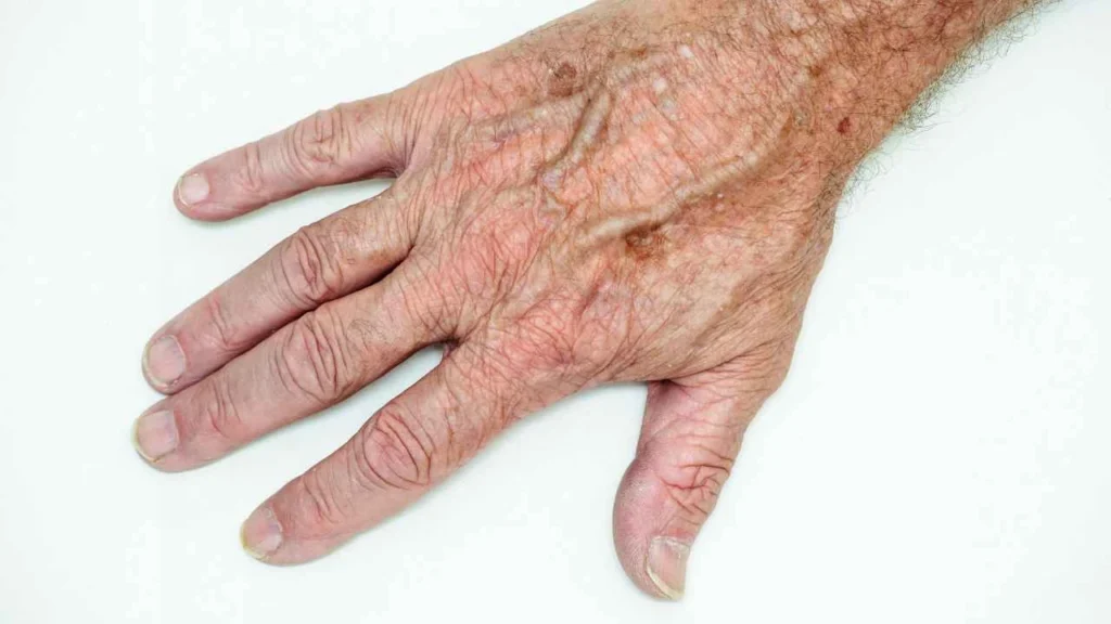 Male hand showing age spot Ellesmere Port
