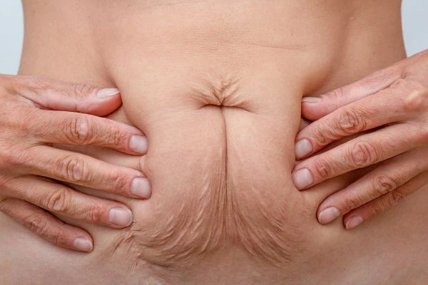 Image of a woman's stomach with loose skin - example of skin tightening Ellesmere Port options