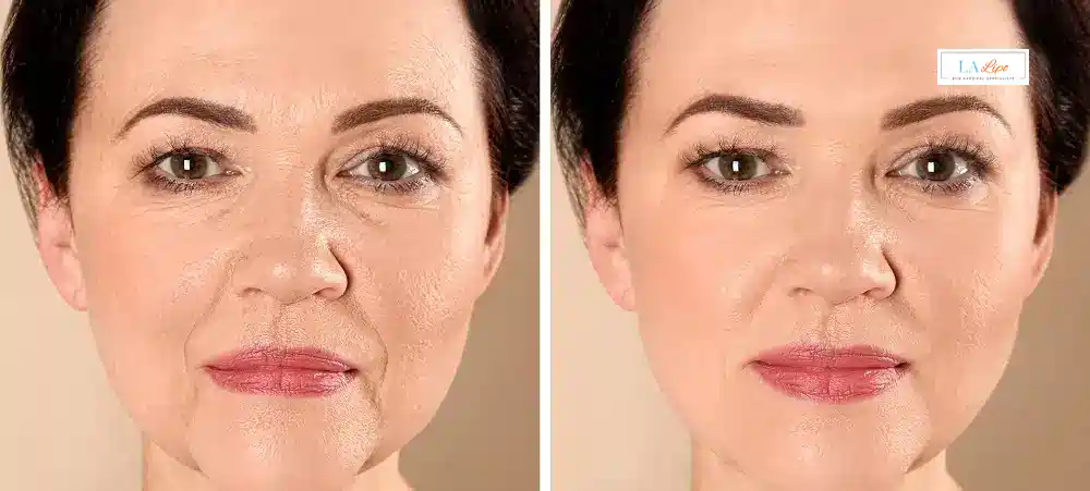 How Long Does It Take to See Results and How Long Do They Last Ellesmere Port?
