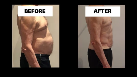 What Symptoms Can Diastasis Recti Cause in Men? Weak Core, Back Pain and Poor Posture Ellesmere Port